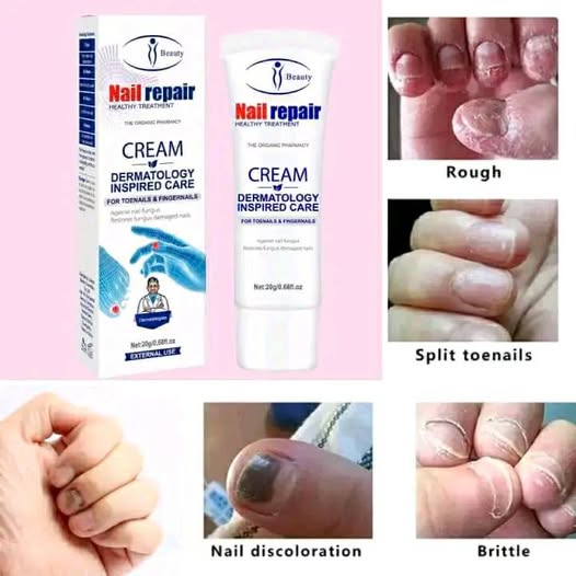 Elimina Hongos de uñas de pies y manos